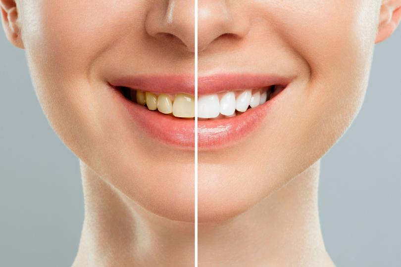 clareamento dental dentista itajaí